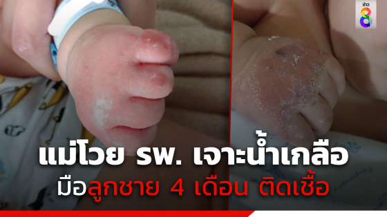 แม่โวยโรงพยาบาลเจาะน้ำเกลือลูกชายวัย 4 เดือน จนมือติดเชื้อ 