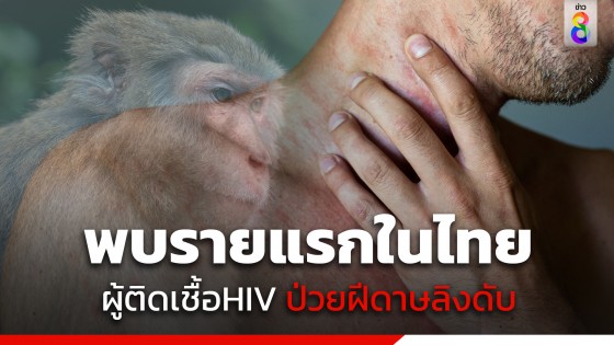 รายแรกในไทย! พบผู้ป่วยติดเชื้อ HIV ป่วยฝีดาษลิงเสียชีวิต