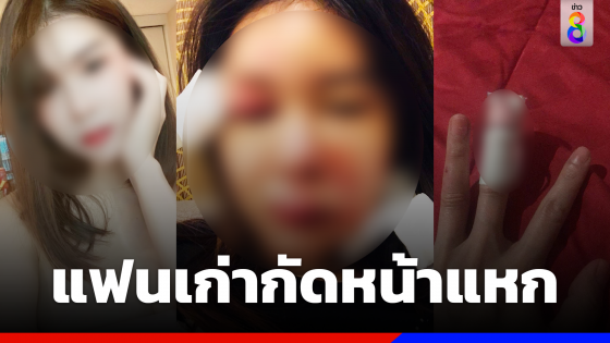 สุดโหด! สาวถูกอดีตแฟนหนุ่มกัดหน้าแหกเสียโฉม