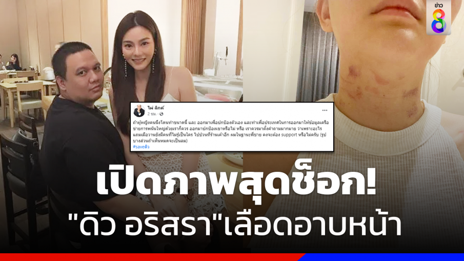 "ไผ่ ลิกค์"เปิดภาพ"ดิว อริสรา"ถูกทำร้ายหนัก ลั่นขอปกป้องในฐานะพี่ชาย