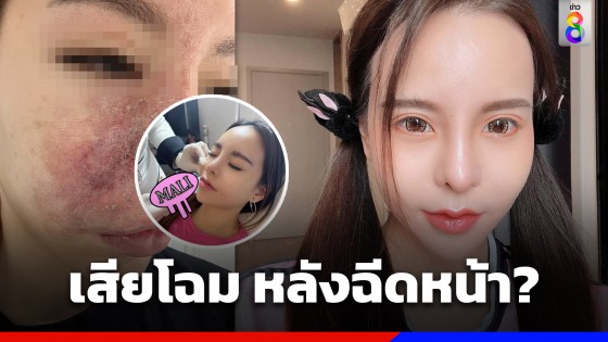 "น้องมะลิ" พริตตี้สาว โพสต์เสียโฉม หลังฉีดหน้า 2 สัปดาห์