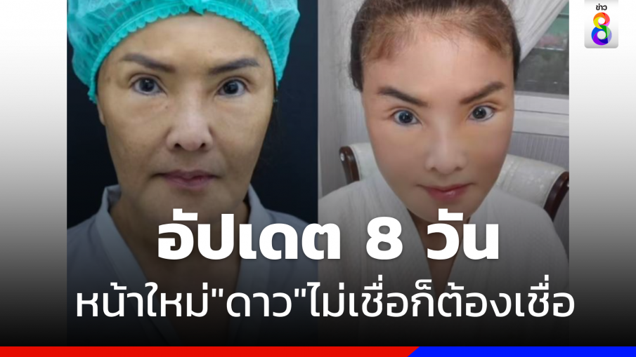 "ดาว มยุรี"  อัปเดตศัลยกรรม 8 วัน  ลั่นไม่เชื่อก็ต้องเชื่อ 