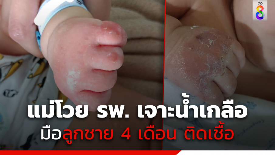 แม่โวยโรงพยาบาลเจาะน้ำเกลือลูกชายวัย 4 เดือน จนมือติดเชื้อ 