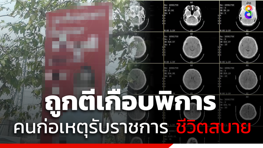 หนุ่มแฉ ถูกร้ายร่างกายจนเกือบพิการ แต่คนก่อเหตุ "รับราชการ" ใช้ชีวิตสบาย