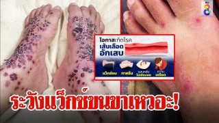 ระวังแว็กซ์ขนขาเหวอะ!...