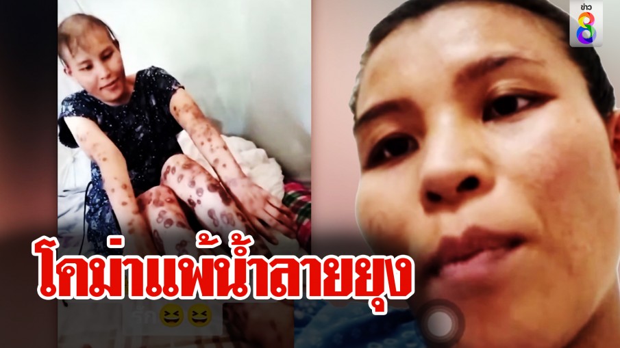 Coma allergic to mosquito saliva