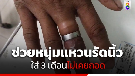 นิ้วบวมเป่ง! กู้ภัยช่วยตัดแหวนจากนิ้วมือหนุ่มวัย 31 ปี หลัง 3 เดือนไม่เคยถอด