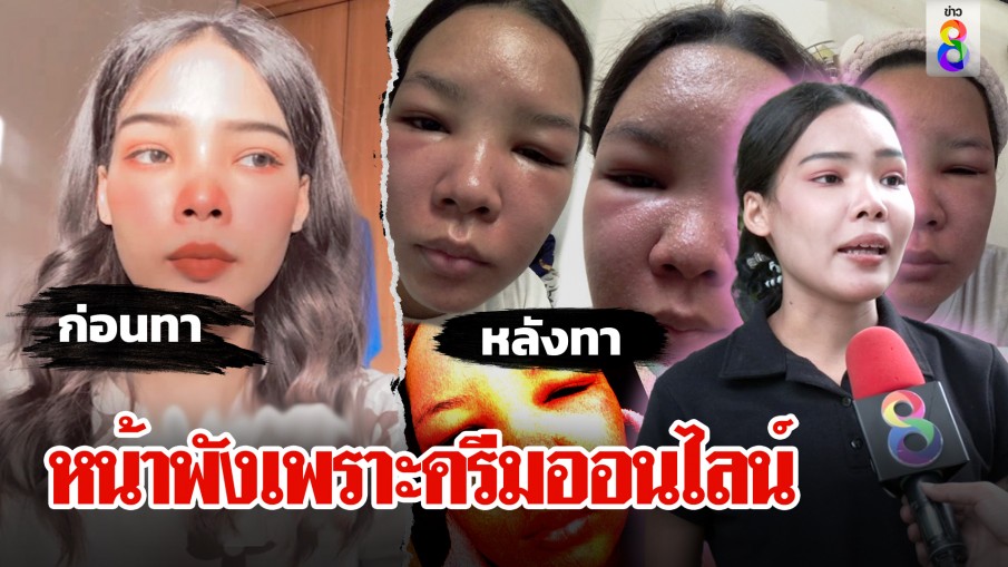 สาวรีวิวซื้อครีมออนไลน์ แพ้หนักหวิดเสียโฉม เตือนนักช้อปคิดหนักก่อนกดโอน