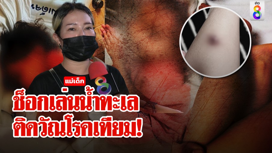 แม่ช็อกลูกน้อยเล่นน้ำน่องเป็นแผลเหวอะคิดว่ายุงกัด พบหมอเจอคำตอบโรคชวนอึ้ง