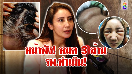 สาวแฉพยาบาล ฉีดยาพลาดทำหน้าพัง อึ้งค่ารักษาทะลุ 3 ล้าน รพ. ไร้เยียวยา
