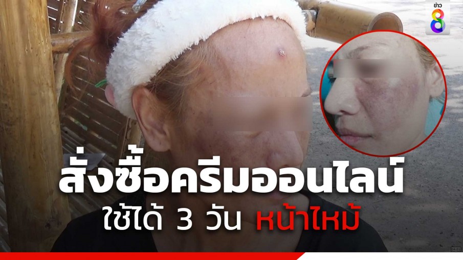 สาวสั่งซื้อครีมออนไลน์ ใช้ได้ 3 วันหน้าไหม้ หวิดเสียโฉม!