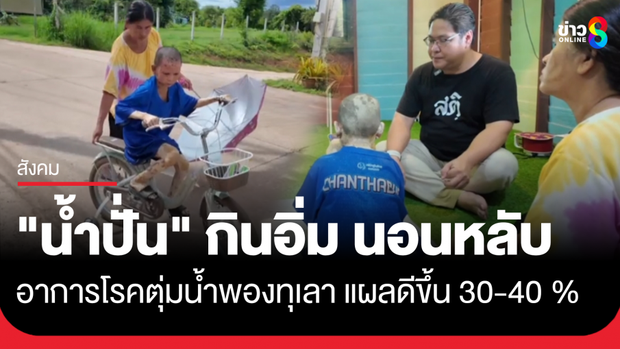 "น้องน้ำปั่น" ยิ้มได้ กินอิ่ม นอนหลับ แผลอาการโรคตุ่มน้ำพองดีขึ้น 30-40 %