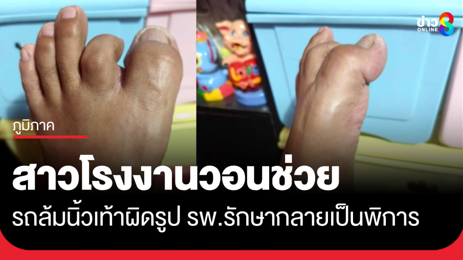 สาวโรงงานวอนช่วย รถล้มนิ้วเท้าผิดรูป รพ.รักษา กลายเป็นนิ้วเท้าพิการ