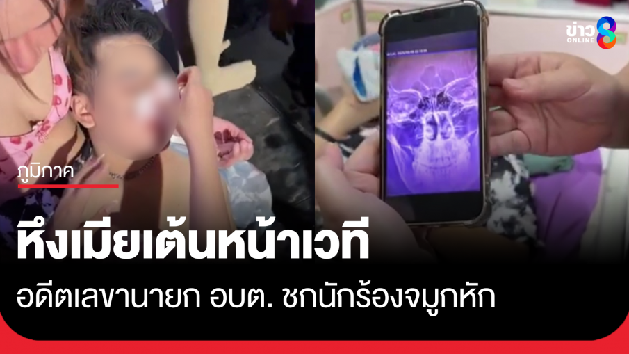 อดีตเลขาฯ นายก อบต. จ.อุทัยธานี หึงเมีย ชกนักร้องจมูกหัก